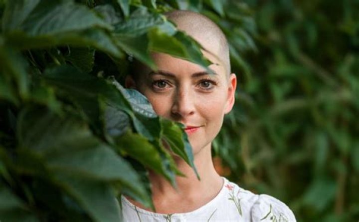 Alopecia Sienna Miller: Understanding the Condition and Its Impact