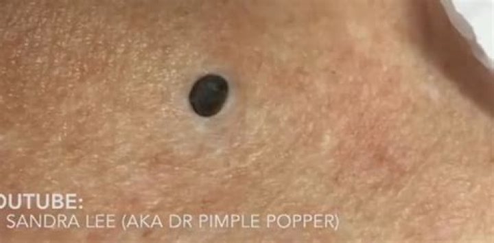 Biggest Blackhead Ever: Unveiling the Shocking Truth About Severe Blackheads