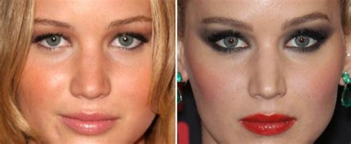 Blepharoplasty Celebrities: Transformations and Trends in Eyelid Surgery