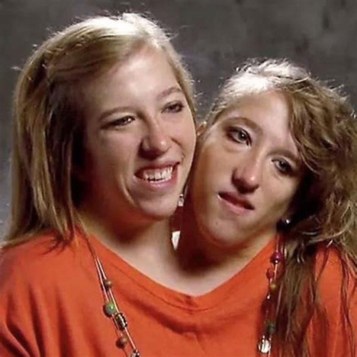 Conjoined Twins Abby and Brittany: Life, Achievements, and Inspirations Today