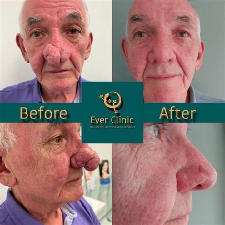 Glasgow Scar: Understanding, Treatment, and Recovery