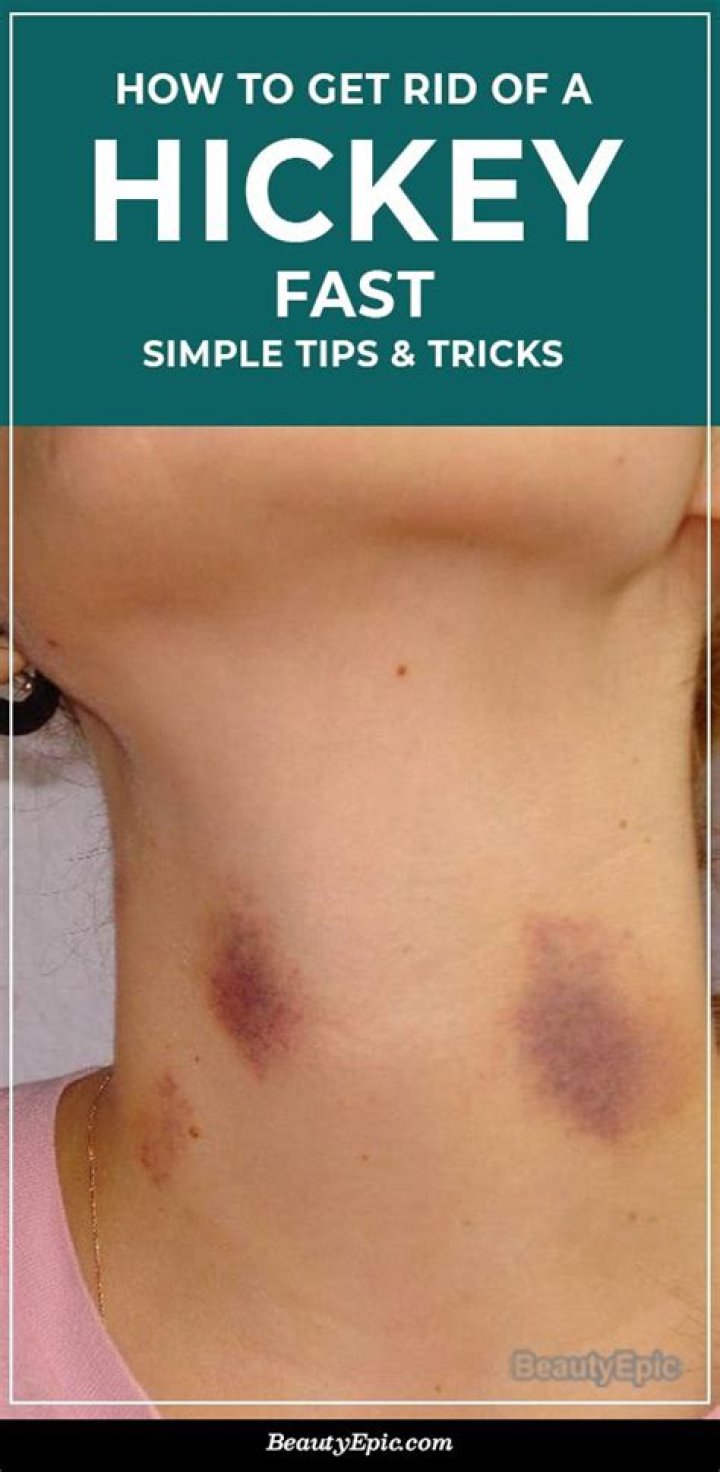 How to Hide Hickey Marks: Expert Tips and Tricks for Quick Cover-Up