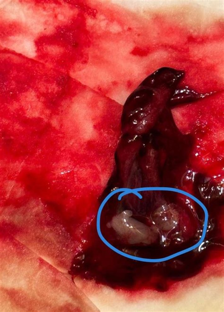 Miscarriage Tissue Pictures at 6 Weeks: Understanding, Identification, and Emotional Support