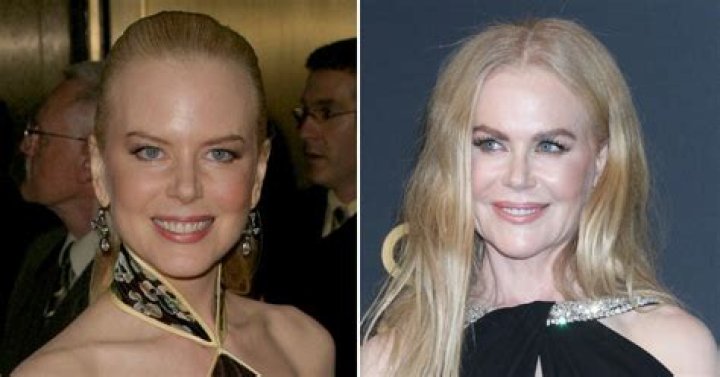 Nicole Kidman Botox: The Truth Behind the Hollywood Legend's Youthful Glow