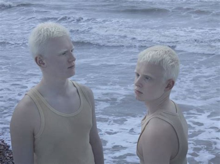 The Palest Person in the World: Exploring Albinism and Its Impact on Life