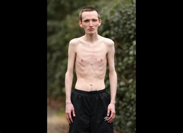 Skinniest Man Alive: Unveiling the Life and Journey of Extreme Weight Loss