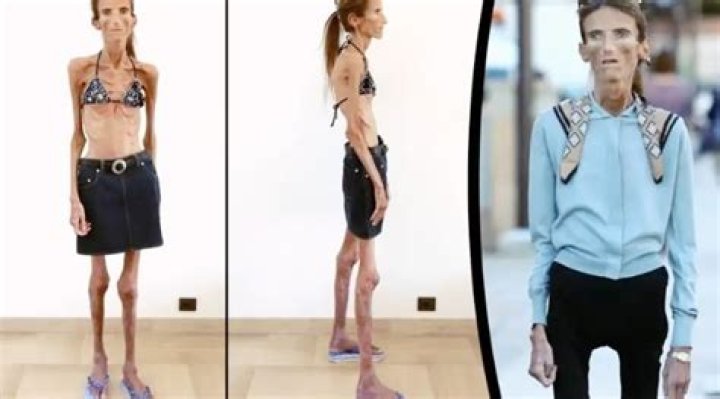 Skinniest Person in the World: Unveiling the Extraordinary Journey of Extreme Weight Loss