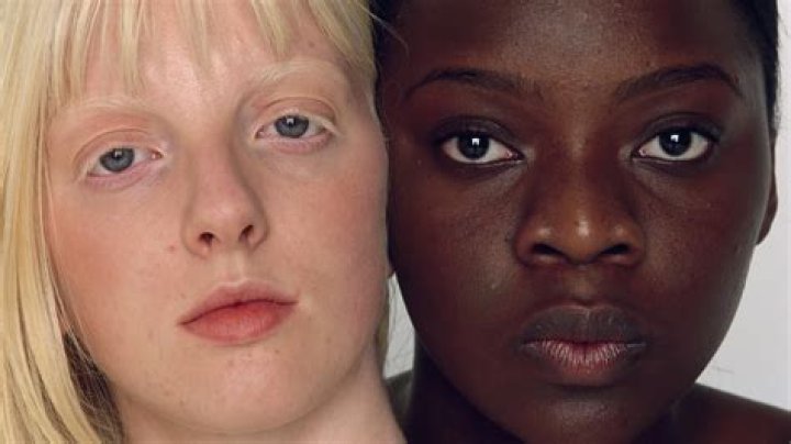 The World&rsquo;s Whitest Person: Exploring the Phenomenon of Albinism and Beyond