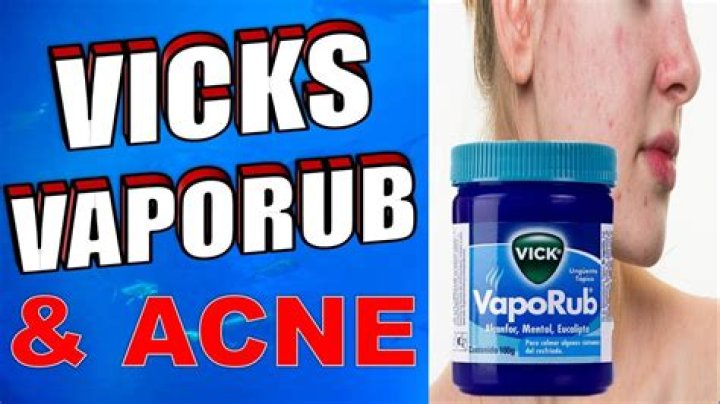Vicks Vaporub for Acne: Does It Work and How to Use It Safely