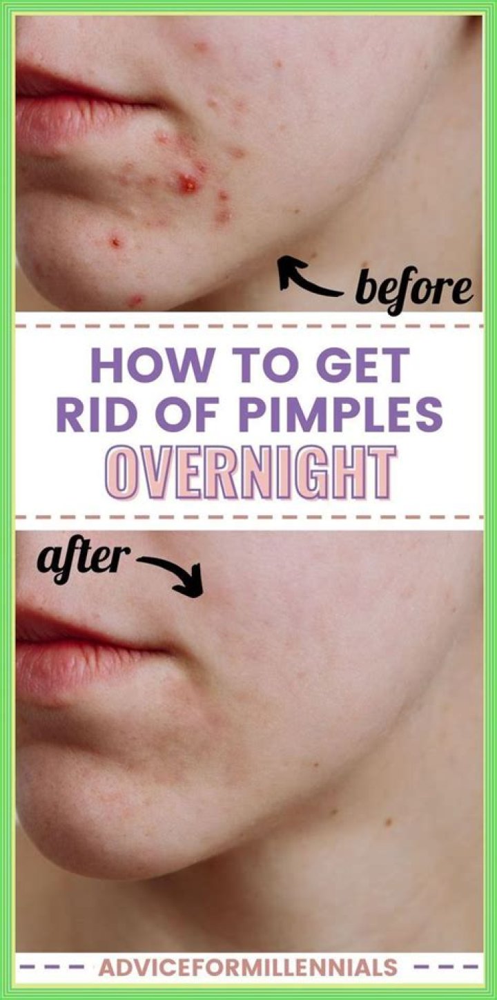 Vicks on Pimples: Does It Work and How to Use It Safely