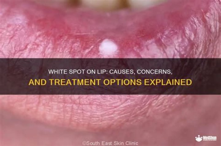 Understanding White Spots on Lips: Causes, Treatments, and Prevention
