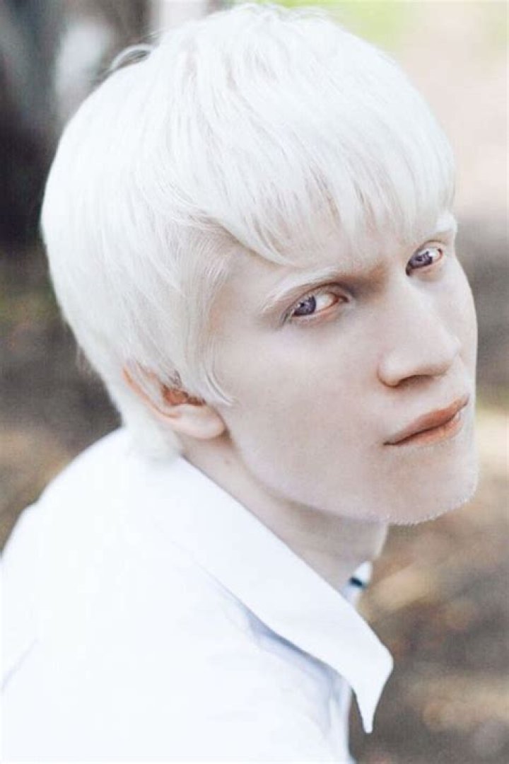 Whitest Person in the World: Exploring the Fascinating World of Albinism